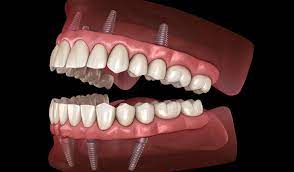 For example, medicare covers oral exams if they're part of a pre. Implant Supported Dentures Voss Dental Oral Surgery Implant