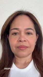 Lifting cervicofacial tunelizado TDL + Blefaroplastia superior e inferior ,  Facial and neck lifting tunneled