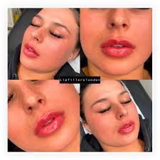 5 star injectable treatments where you will walk away with that wow effect, all day long. Lip Fillers London Qualified Insured Aesthetics Practitioners