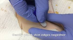 Image result for Tissue Adhesive