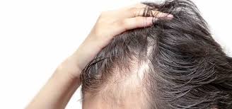 La caduta può essere distribuita su tutto il cuoio capelluto, oppure può . Stempiatura Fisiologica Uomo E Donna A Quale Eta Rimedi