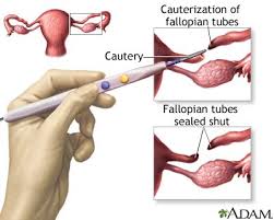 Tubal Ligation In 2020 Female Sterilization Birth Control Options Birth Control