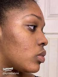 Top Products to Effectively Clear Acne Scars