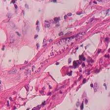 A histologia é uma pericardite crônica inespecífica. Https Www Um Es Analesdebiologia Numeros 38 Pdf 38 2016 03 Pdf