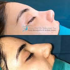 Thick Skin Bulbous Tip Rhinoplasty Assoc Prof Dr Suleyman Tas Rhinoplasty Nose Jobs Rhinoplasty Thick Skin