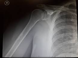 omuz yirtigi tipleri omuzda lif yirtilmasi doktor fizik