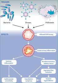 Image result for COPD Exacerbation Prevention