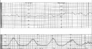 Image result for Contraction Stress Test