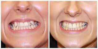 However, the national average price for invisalign is between $3,000 and $5,000. Invisalign Southgate Invisalign Barnet Finchley