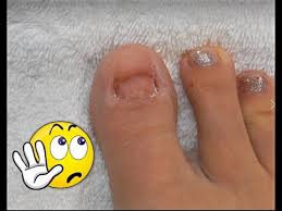 Sandal season is near so there's no reason not to do some nail art on your toes, right? No Toenails Make Some Acrylic Glitter Toesnails Using Dual Forms Youtube