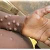 It is a disease caused by the monkeypox virus. 1
