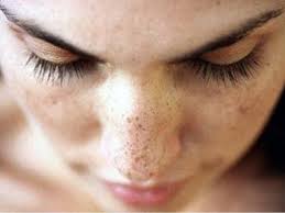 Sivilce Delikleri Nasil Gecer Maskeler Cil Hamilelik