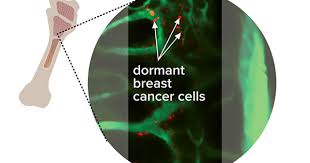 Thus, germs spread quickly throughout a small town. Cancer S Spread To Bone National Cancer Institute