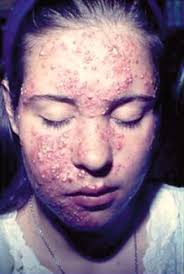 Dioxins are found throughout the world in the environment and they accumulate in the food chain, mainly in the fatty tissue of animals. Clinical Aspects Of Acne Vulgaris Springerlink