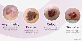 Skin cancer is the most common cancer in the united states. Melanoma Symptoms And Signs Extensive Guide
