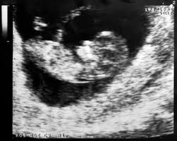11 Schwangerschaftswoche 11 Ssw Fotus Fetus Beginn Der Fetalzeit Nackenfaltenmessung