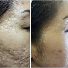 Bye Bye Acne Scarring Uneven Skin Texture Essential Oils For Face Skin Textures