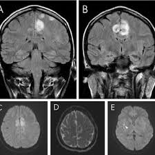 Herpes simplex encephalitis (hse) is the most common form of viral sporadic encephalitis and, when left untreated, has a mortality rate of 70% (3, 22). Pdf Herpes Simplex Encephalitis Presenting With Exclusively Frontal Lobe Involvement