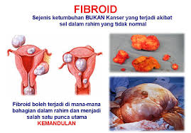 Mereka bergantung kepada saiz dan lokasi struktur. Premium Beautiful Expert By Norasma Md Noor Bio Seleza Merawat Untuk Fibroid Cyst