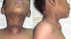 Synonyms for sternal notch in free thesaurus. Tuberculous Suprasternal Notch Abscess In A Child Bmj Case Reports