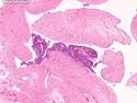 Affects the surface of mesothelial cells in the pleura, though can also occur in the pericardium, tunica vaginalis and peritoneum. Mesothelial Hyperplasia
