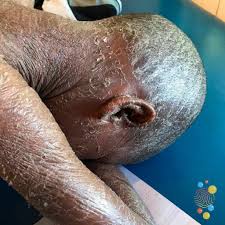 Image result for Ichthyosis