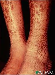 Image result for Ichthyosis