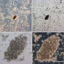 Abundant Amorphous Phosphate With A Pseudocast Phase Contrast Bright Field Original Magnification X100 X400 Urinarysediment Urine Nephrology Nephpearls