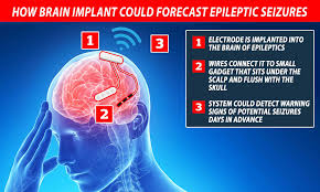 The type of symptoms and seizures depend on where the abnormal electrical activity takes place in the brain, what its cause is, and such factors as the patient's. Brain Implant Can Forecast Epileptic Seizures Days Beforehand Daily Mail Online