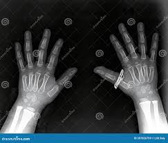 Image result for Hand Growth Plates