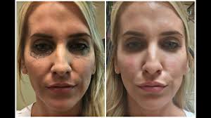 Hello i've just made a binance account and i've sent over some ltc from bittrex to binance. Under Eye Filler Vlog Before After Youtube