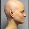 Such phases are referred to as alopecia diffusa or effluvium. 1