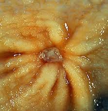 Choosing the right foods is also important to improve, treat, and prevent the duodenal ulcer pain. Peptic Ulcer Disease Wikipedia