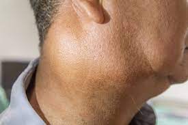 Red or white patch in the mouth. One Stop Neck Lump Clinic Neck Lump Diagnosis New Victoria Hospital London Surrey Kingston