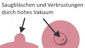 Wunde Brustwarzen Beim Stillen Still Lexikon