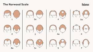 The hairline stays at stage 2, but there is significant hair loss on the top of the scalp (the vertex). The Norwood Scale Hair Loss Stages Treatments Hims