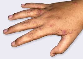 Image result for scabies symptoms