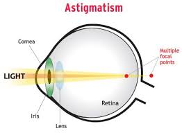 Astigmatism It Is A Type Of Distorted Vision Caused By A Defect In The Curvature Of The Co Contact Lenses For Astigmatism Astigmatism Halloween Contact Lenses