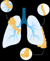 Lung cancer originates in the lungs, but it can spread. Mesothelioma Learn About Malignant Mesothelioma Cancer