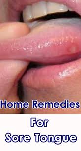 Listed Are Some Of The Best Home Remedies To Get Rid Of Sore Tongue Soretongue Homeremedies Tongue Glyc Tongue Sores Tongue Ulcer Remedies Ulcer On Tongue
