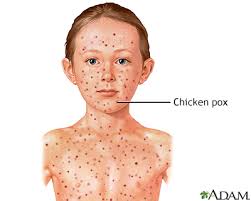 If given to those who are not immune within five days of exposure to chickenpox it prevents most cases of disease. Chickenpox Varicella Vaccine What You Need To Know Information Mount Sinai New York