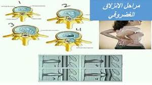 مراحل الانزلاق الغضروفي بالصور الدسك Herniated Disc Herniated