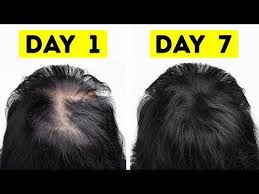 I Went From Thin To Thick Hair In Just A Week Youtube Thick Hair Styles Homemade Hair Treatments Hair Remedies For Growth