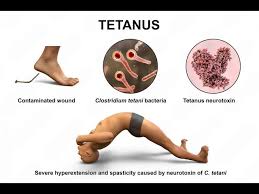 Image result for Tetanus