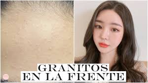Como Quitar Los Granitos De La Frente Carmen Rodriguez Youtube