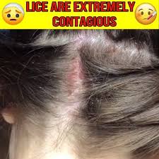 Electric Head Lice Exterminator 35 95 Video In 2020 Lice Removal Dandruff Remedy Hair Lice