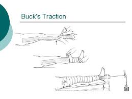 Jun 25, 2021 · the candidacy of jacque vaughn as head coach of the new orleans pelicans is gaining traction, according to espn's brian windhorst. Musculoskeletal Fractures Nancy Lin Rn Ms Adapted From
