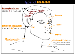 Headache Chart Tension Headache Causes Headache Location