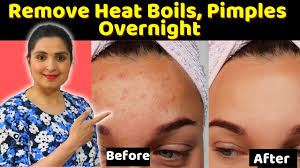 Leave it for 20 to 30 minutes and pat dry with a clean towel. Cure Prickly Heat Rashes Sweat Pimples Heat Boils Ancient Remedy To Remove Prickly Heat Rashes Youtube