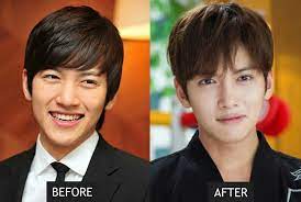 May 23, 2017 @ 8:53 pm. 21 Korean Celebs Who Have Undergone Cosmetic Procedures Or Surgery Koreaboo